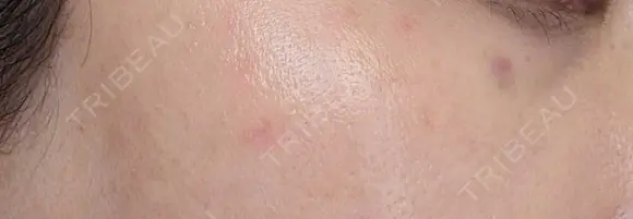 ピコスポット G MEDICAL ART クリニック 新宿院 DAY 5 メイン用