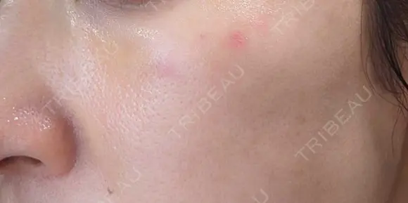 ピコスポット G MEDICAL ART クリニック 新宿院 DAY 5 メイン用