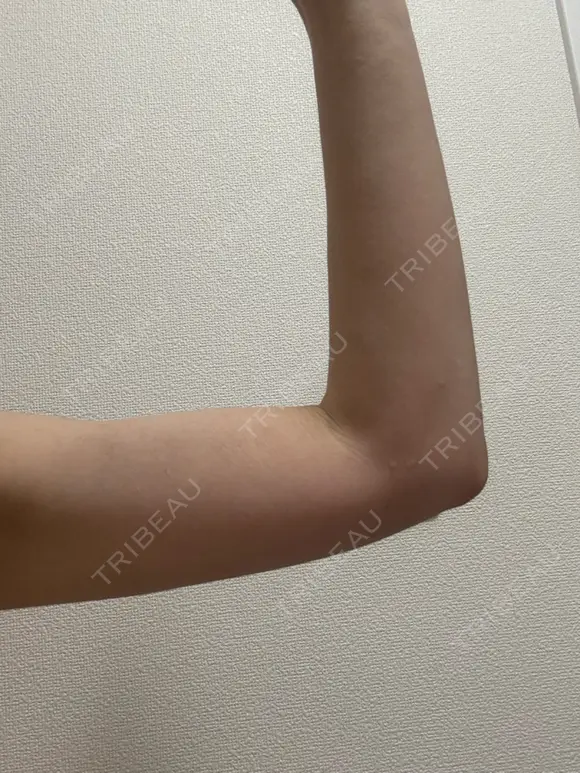 脂肪吸引（二の腕） イテウォンビューティークリニック 名古屋栄院 DAY 31 メイン用