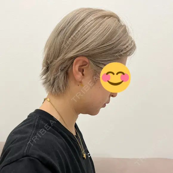 脂肪吸引（顔） お茶の水美容形成クリニック DAY 2 メイン用