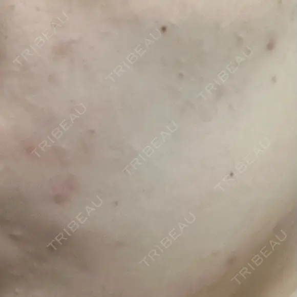 ポテンツァ 渋谷美容外科クリニック 横浜院 DAY 17 メイン用