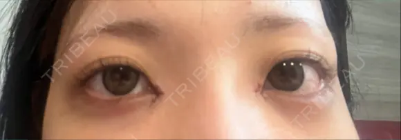 目頭切開 Brandnew Beauty Clinic DAY 0 メイン用