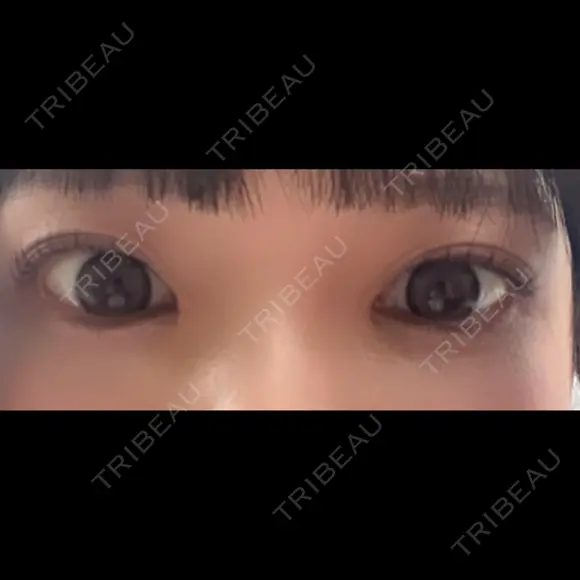 目頭切開 Brandnew Beauty Clinic DAY 6 メイン用