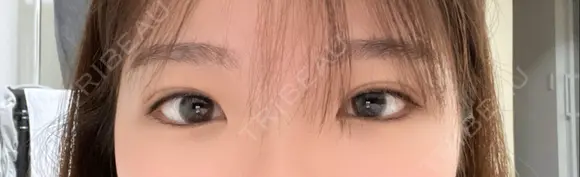 二重埋没 R Beauty CLINIC 名古屋院 DAY 8 メイン用