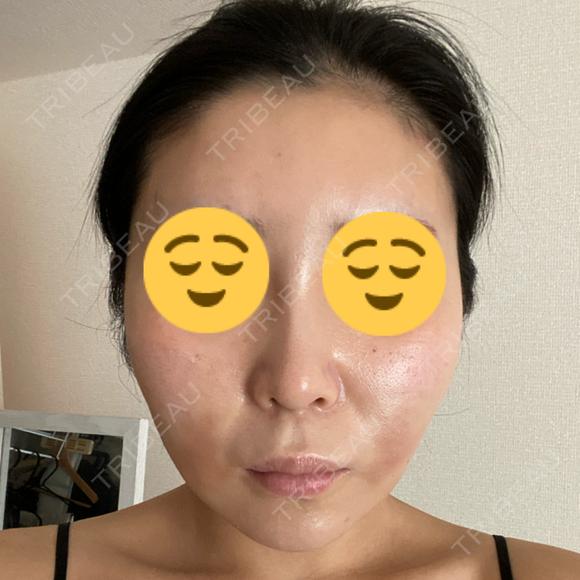 糸リフト / 脂肪吸引注射（顔） 湘南美容クリニック 川崎院 DAY 1 メイン用
