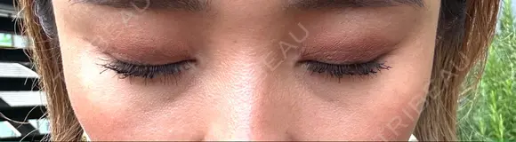 クマ治療 / 下まぶたの脂肪取り Tokyo Tensei Clinic 新宿院 AFTER メイン用