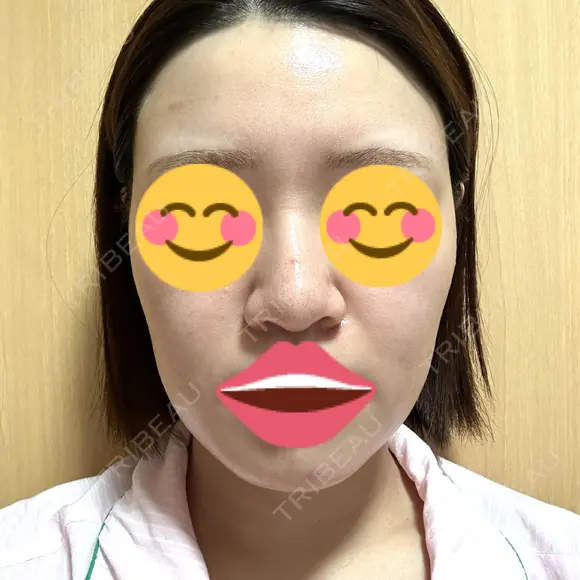 ボトックス（あご） / ボトックス（エラ・小顔） / ボトックス（肩） / ハイフ（顔） TCB東京中央美容外科 船橋院 DAY 1 メイン用