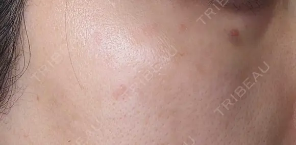 ピコスポット G MEDICAL ART クリニック 新宿院 DAY 7 メイン用