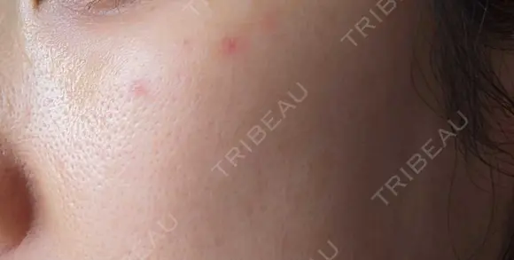 ピコスポット G MEDICAL ART クリニック 新宿院 AFTER メイン用