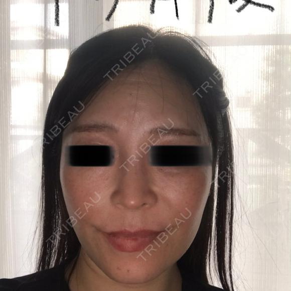 鼻尖形成（切開） / 鼻中隔延長（切開） / 軟骨移植 WOM CLINIC GINZA （ワム クリニック ギンザ） DAY 47 メイン用