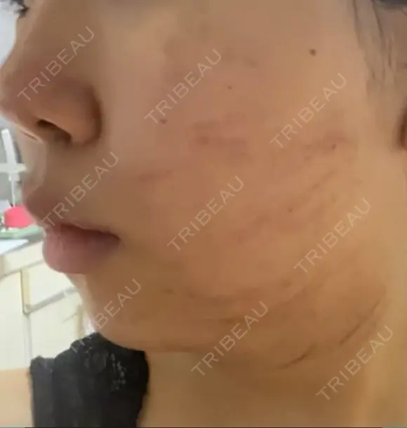 ハイフ（顔） 表参道美容外科クリニック DAY 0 メイン用