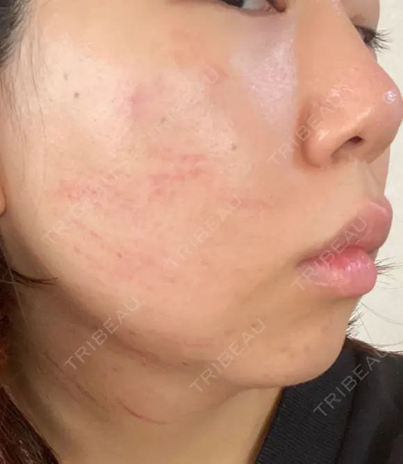 ハイフ（顔） 表参道美容外科クリニック DAY 1 メイン用