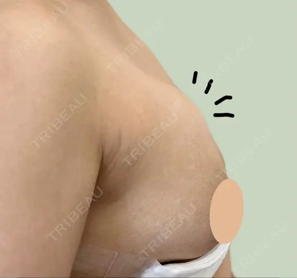 その他（胸） WOM CLINIC GINZA （ワム クリニック ギンザ） DAY 17 メイン用