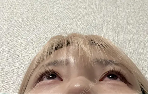 ヒアルロン酸注入（涙袋） ファイヤークリニック 渋谷院 DAY 0 メイン用