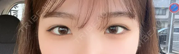 二重埋没 R Beauty CLINIC 名古屋院 DAY 10 メイン用