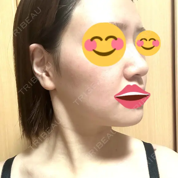 ボトックス（あご） / ボトックス（エラ・小顔） / ボトックス（肩） / ハイフ（顔） TCB東京中央美容外科 船橋院 DAY 2 メイン用