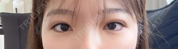 二重埋没 R Beauty CLINIC 名古屋院 DAY 11 メイン用