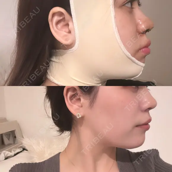 その他（鼻） / バッカルファット除去 / 鼻尖形成（非切開） / 小鼻縮小（非切開） / ボトックス（エラ・小顔） / ヒアルロン酸注入（唇） / ボトックス（肩） TCB東京中央美容外科 広島院 AFTER メイン用