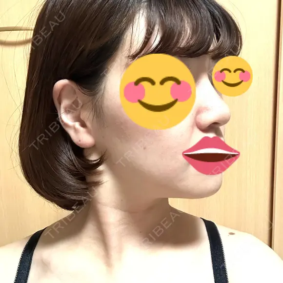 ボトックス（あご） / ボトックス（エラ・小顔） / ボトックス（肩） / ハイフ（顔） TCB東京中央美容外科 船橋院 DAY 4 メイン用