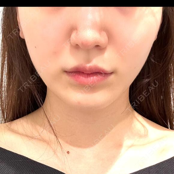 糸リフト / 脂肪吸引（顔） / ジョールファット除去 / ボトックス（エラ・小顔） R Beauty CLINIC 名古屋院 DAY 30 メイン用