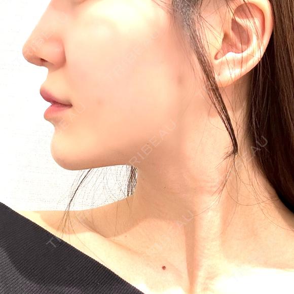 糸リフト / 脂肪吸引（顔） / ジョールファット除去 / ボトックス（エラ・小顔） R Beauty CLINIC 名古屋院 DAY 30 メイン用