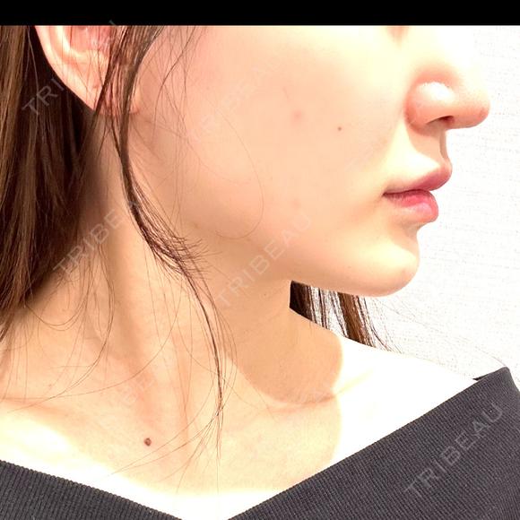 糸リフト / 脂肪吸引（顔） / ジョールファット除去 / ボトックス（エラ・小顔） R Beauty CLINIC 名古屋院 DAY 30 メイン用