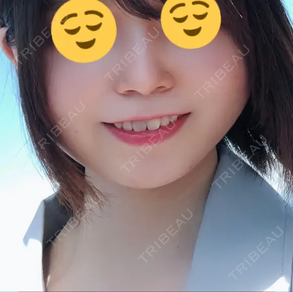 骨削り（頬） 湘南美容クリニック 新橋銀座口院 DAY 28 メイン用