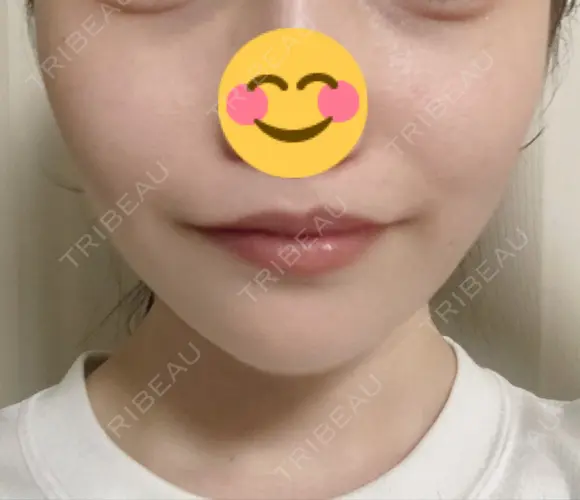骨削り（頬） 湘南美容クリニック 新橋銀座口院 AFTER メイン用