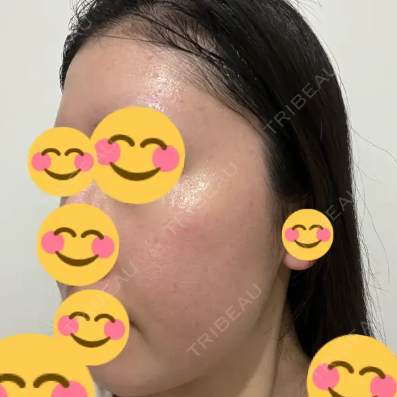 光治療（フォトフェイシャルなど） DMTC美容皮膚科 大宮院 DAY 21 メイン用