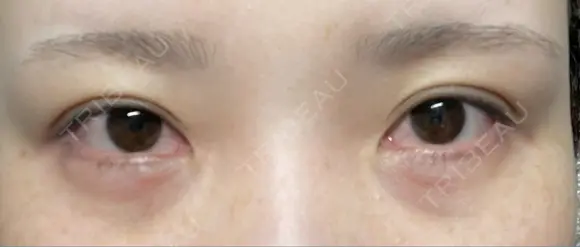 ヒアルロン酸注入（涙袋） ファイヤークリニック 渋谷院 AFTER メイン用