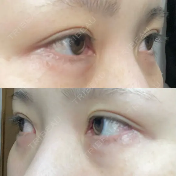 ヒアルロン酸注入（涙袋） ファイヤークリニック 渋谷院 DAY 3 メイン用