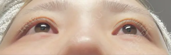 ヒアルロン酸注入（涙袋） ファイヤークリニック 渋谷院 DAY 3 メイン用