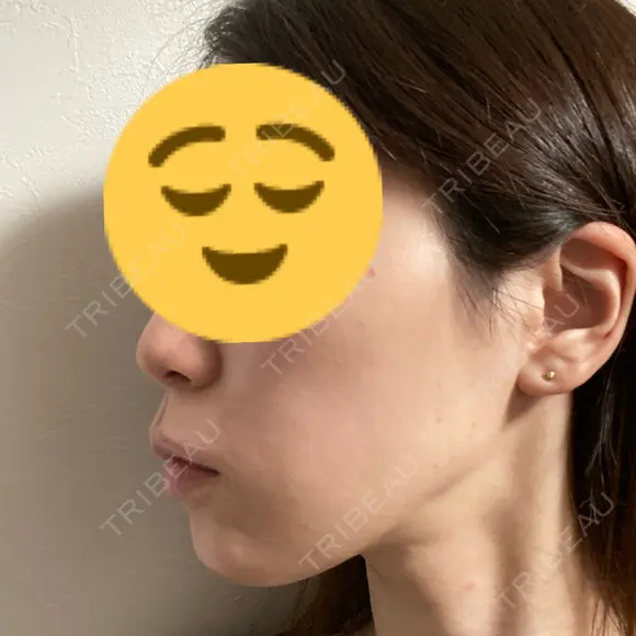 ボトックス（あご） / ヒアルロン酸注入（あご） / ヒアルロン酸注入（唇） KAGA CLINIC DAY 1 メイン用