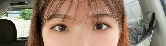 二重埋没 R Beauty CLINIC 名古屋院 DAY 13 メイン用