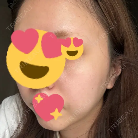 ピコレーザートーニング（美白・肝斑） / レーザートーニング（美白・肝斑） ルラ美容クリニック 渋谷本院 DAY 3 メイン用