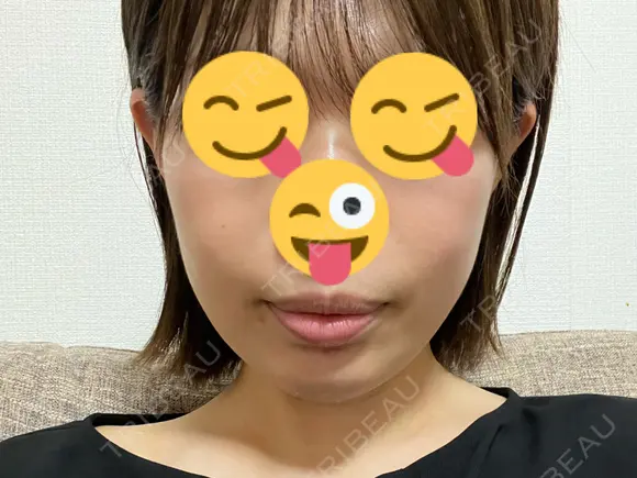 ボトックス（エラ・小顔） / ハイフ（顔） 東京美容医療クリニック 池袋院 DAY 1 メイン用