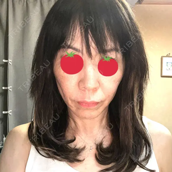 ボトックス（あご） / ボトックス（口角） / ボトックス（眉間） / ボトックス（目尻） / ボトックス（額） / ボトックス（人中） DMTC美容皮膚科 大宮院 DAY 0 メイン用