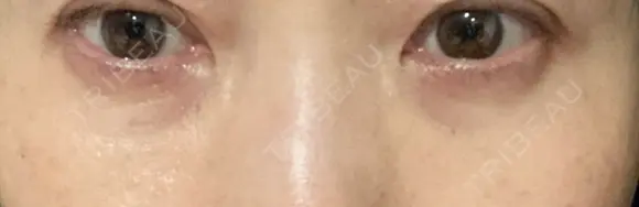 下まぶたの脂肪取り / 脂肪注入（肌） / 脂肪注入（目の下） X CLINIC 大阪院 AFTER メイン用