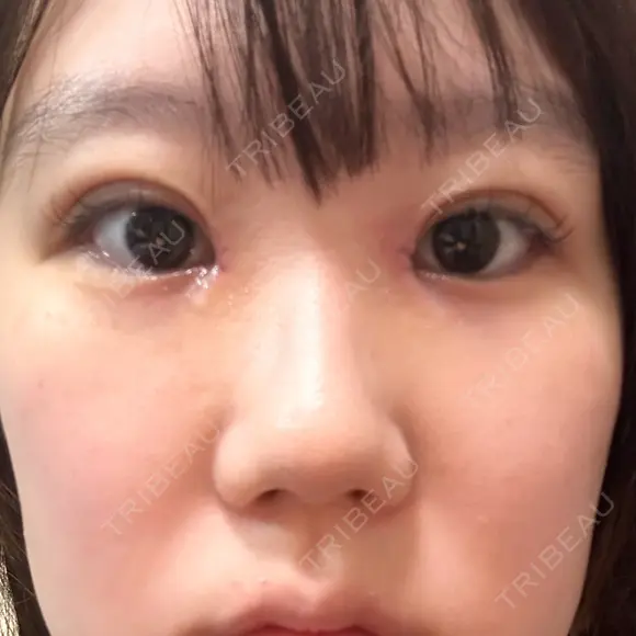 二重埋没 / 目頭切開 Olino美容外科・美容皮膚科 DAY 6 メイン用