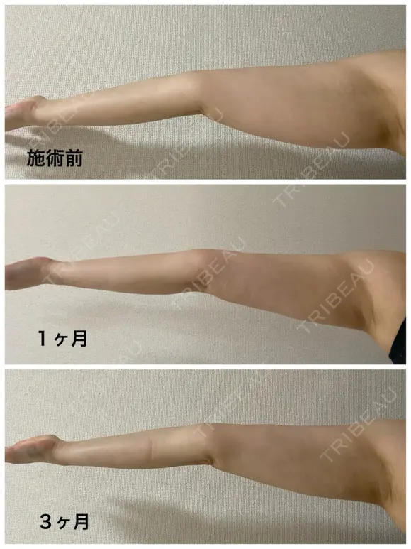 脂肪吸引（二の腕） / 脂肪吸引（肩） Mods Clinic（モッズクリニック） 大阪院 DAY 91 メイン用