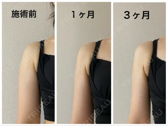 脂肪吸引（二の腕） / 脂肪吸引（肩） Mods Clinic（モッズクリニック） 大阪院 DAY 91 メイン用