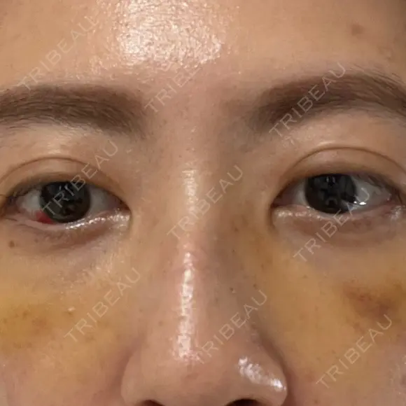 下まぶたの脂肪取り APOLLO BEAUTY CLINIC DAY 8 メイン用