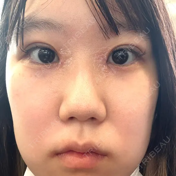 二重埋没 / 目頭切開 Olino美容外科・美容皮膚科 DAY 7 メイン用