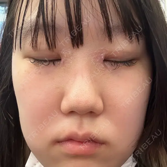 二重埋没 / 目頭切開 Olino美容外科・美容皮膚科 DAY 7 メイン用
