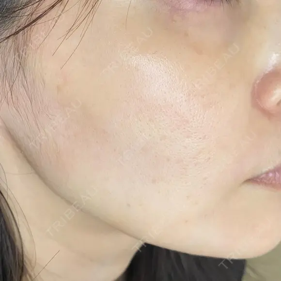 その他（肌） / ポテンツァ オラクル美容皮膚科 大阪梅田院 DAY 0 メイン用