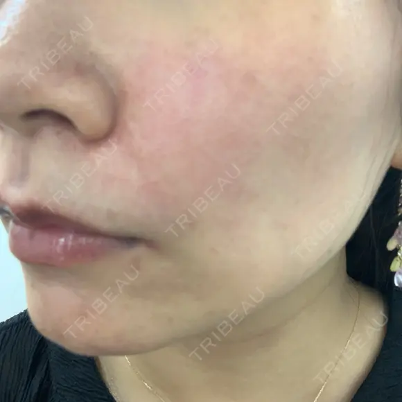 ヒアルロン酸注入（頬） 渋谷美容外科クリニック 渋谷院 DAY 0 メイン用