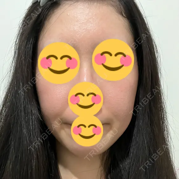 光治療（フォトフェイシャルなど） DMTC美容皮膚科 大宮院 AFTER メイン用