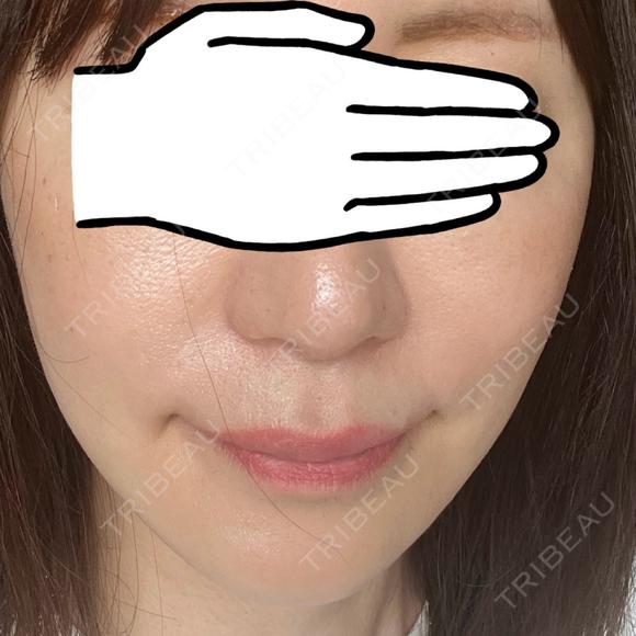 ヒアルロン酸注入（頬） サフォクリニック AFTER メイン用