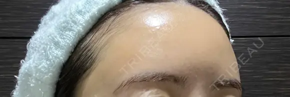 脂肪注入（額） / ボトックス（眉間） / ボトックス（額） GRACIA clinic 【グラシアクリニック】 DAY 16 メイン用
