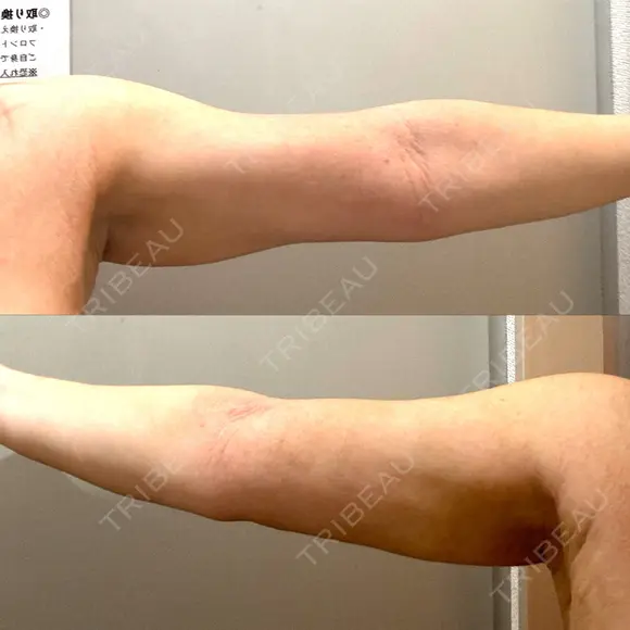 脂肪吸引（顔） / 脂肪吸引（二の腕） / 脂肪注入（額） / 脂肪吸引（肩） Mods Clinic（モッズクリニック） 福岡院 DAY 78 メイン用